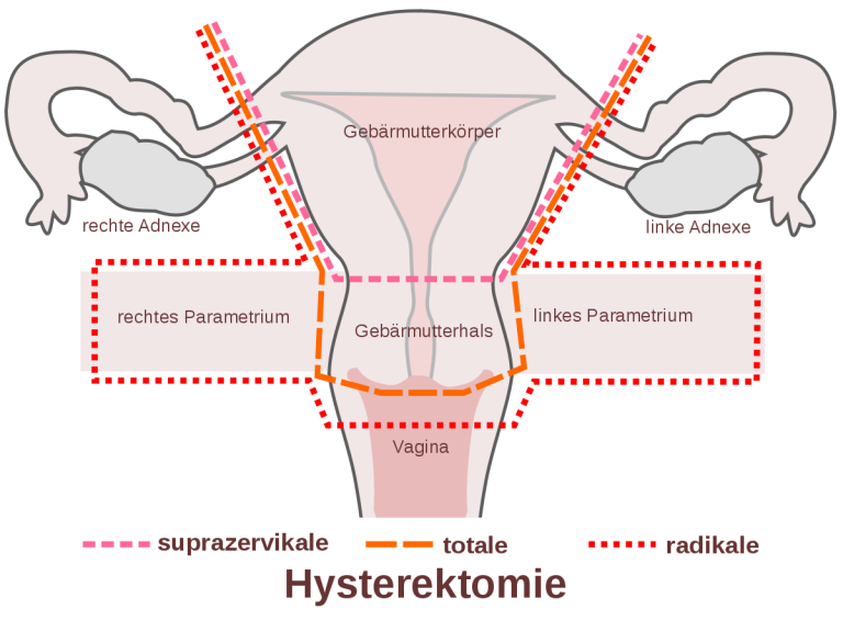 Hysterektomie, Gebärmutterentfernung.